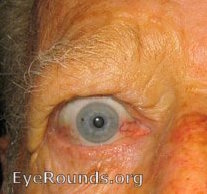 Conjunctival Injection. Note the dilation of the nasal and temporal conjunctival vessels. (larger image not available)