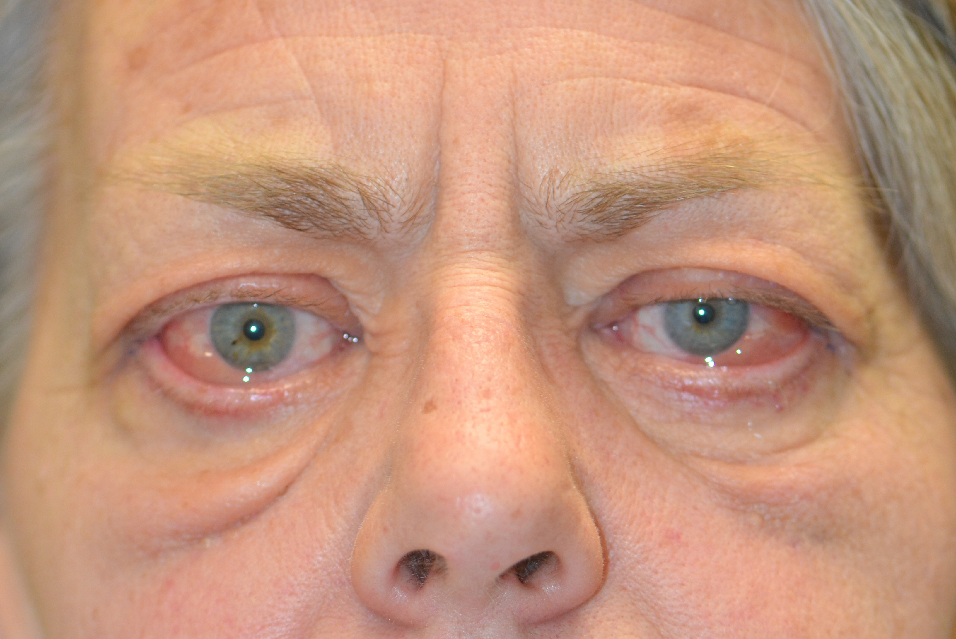 oedema around eye